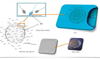 La PICSI pour aider à choisir le bon spermatozoïde