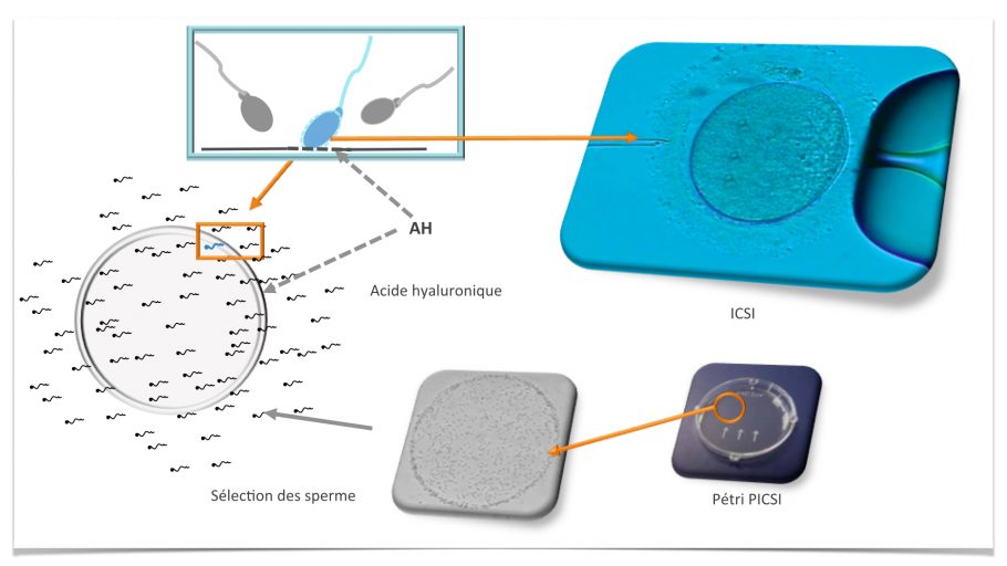 fertilys clinique fertilite blogue picsi choisir spermatozoide