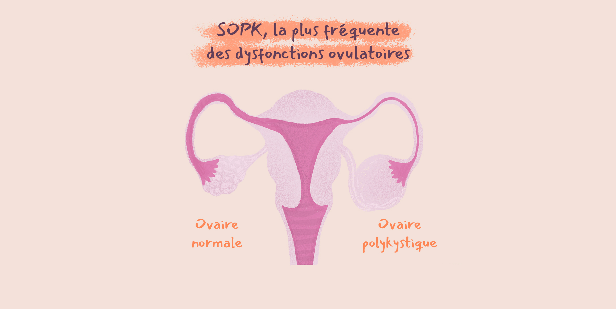 Le Syndrome des Ovaires Polykystiques (SOPK) risques et traitements